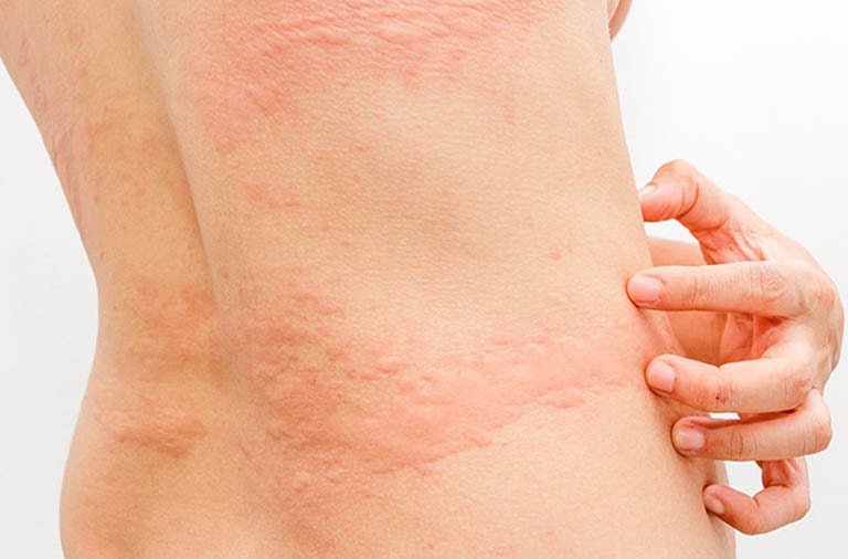 20210520_082049_090353_di-ung-thuc-pham-max-1800x1800-1 Dị ứng thực phẩm